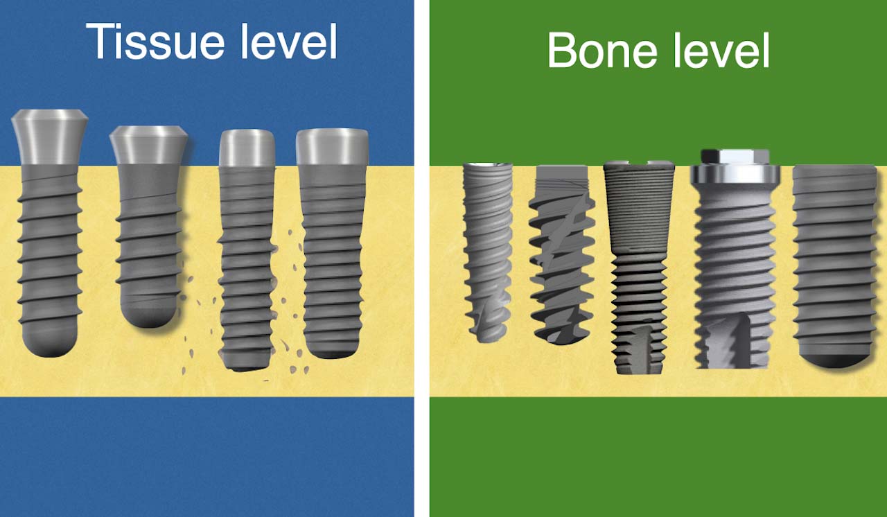 Bone Level vs tissue level implants